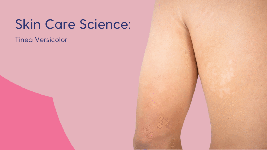 What It Is and How It Is Treated
– Skin Type Solutions