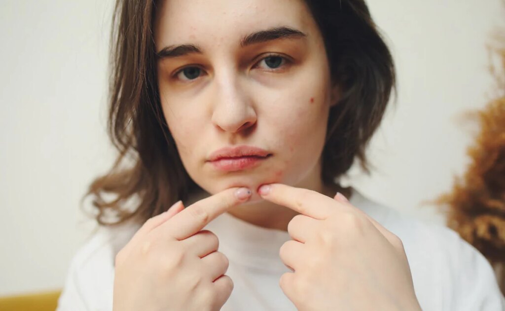 Hormonal Breakouts? Avoid These 10 Skincare Mistakes